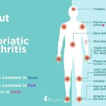 Gout arthritis symptoms vs preventing